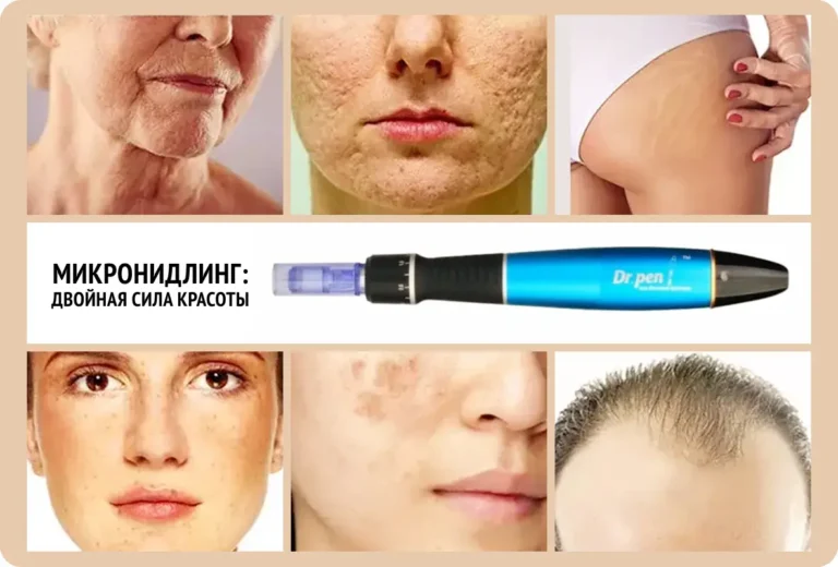 микронидлинг что делает