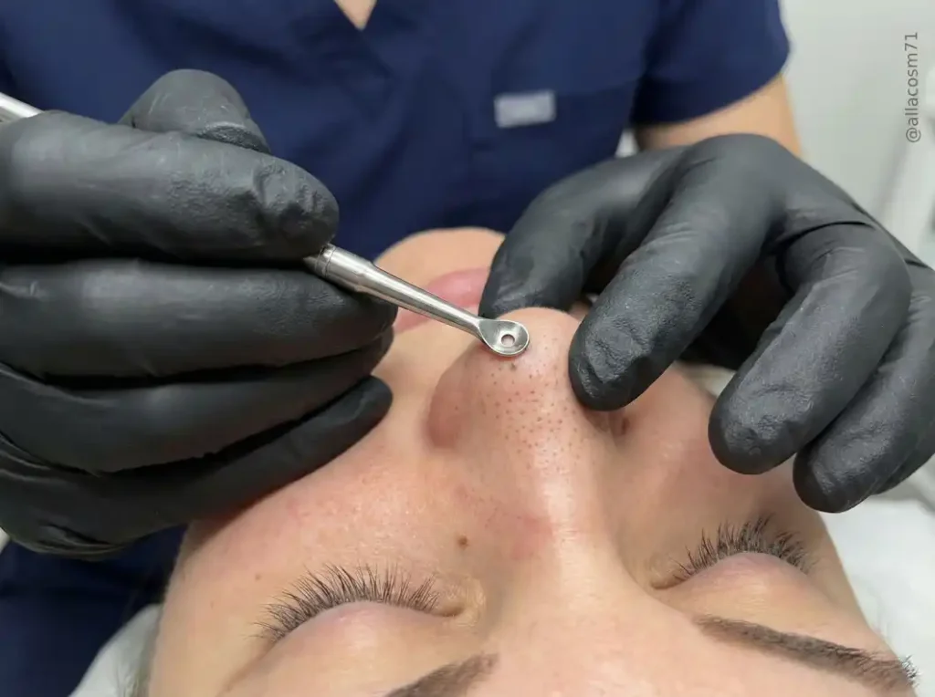 Алла удаляет черные точки на носу ложкой уно