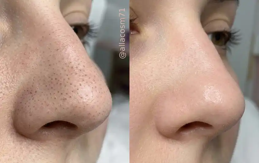 черные точки чистка