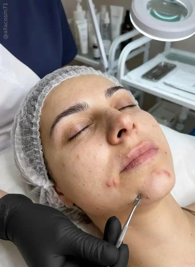 чистка черных точек и угрей, черные точки чистка от угрей, чистка лица черные точки угри, черные точки чистка новые, чистка комедонов и черных точек, чистка кожи от черных точек, атравматичная чистка лица, механическая чистка лица