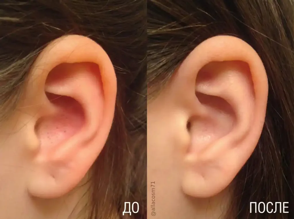 черные точки в ушах , удаление черных точек в ушах, черные точки в ушах удаление, давит черные точки в ухе, можно ли давить черные точки в ушах, уши черных точек и угрей, черный точки ухо , чистка ушей от угрей и черных точек, чистка ушей от черных точек, чистка ушей черные точки, черные точки в ушах как избавиться, черные точки внутри уха, черные точки в ушах подростка, чистим уши от черных точек