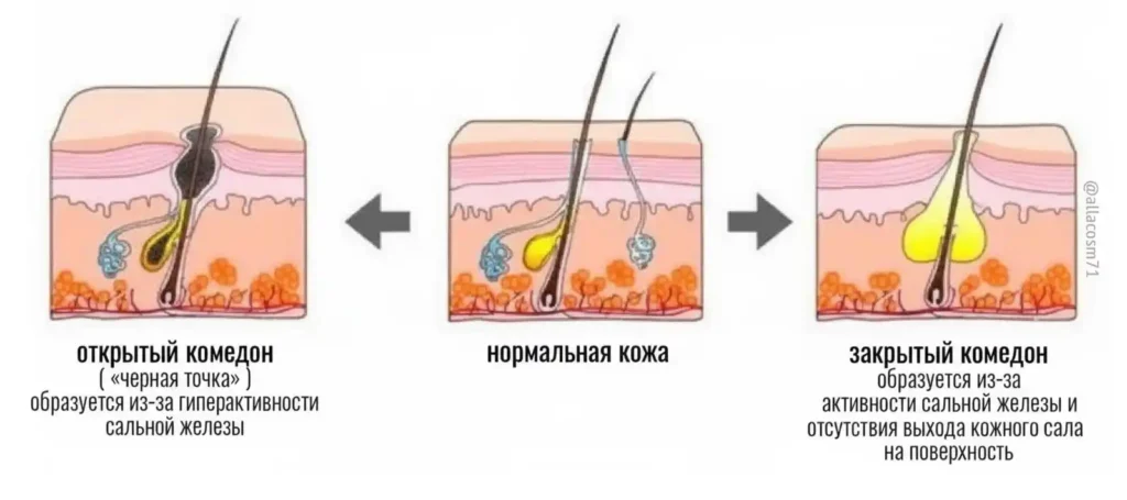 виды комедонов, типы комедонов, открытый комедон, закрытый комедон